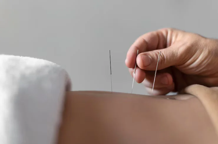 close-up-hand-holding-acupuncture-needle_23-2148815311 (1)